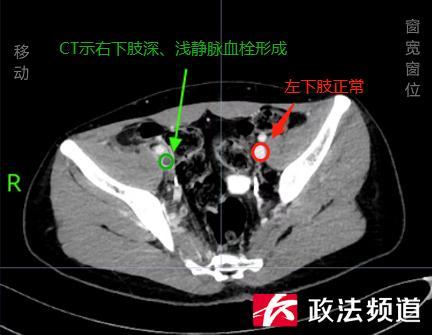 男朋友用筋膜枪把我玩哭(女性用筋膜枪好吗)插图